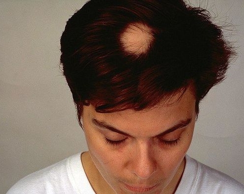 alopecia areata