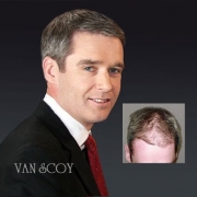 best surgical hair transplants columbus cleveland ashland ohio
