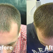 laser hair therapy results
