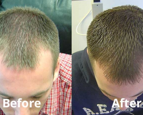 laser hair therapy results