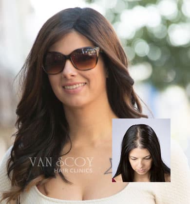 female hair loss replacement treatment columbus ashland cleveland ohio