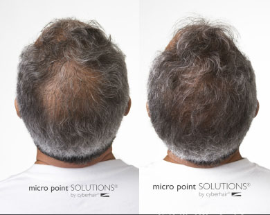 micro point hair additions for men ohio