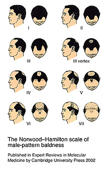 norwood baldness progression in men