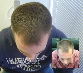 ohio laser hair loss treatment therapy