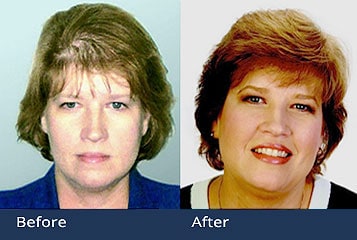 Female Hair Transplants Ohio