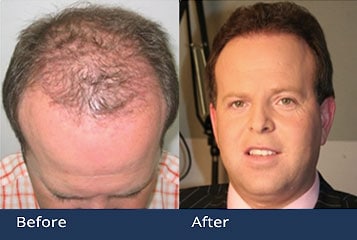 PAI Hair Transplant Restoration Cleveland Ohio