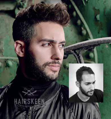 hairskeen hair replacement cleveland ashland columbus elyria ohio