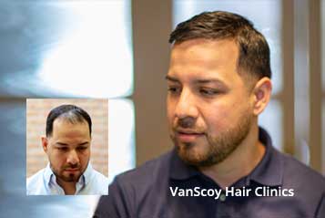 mens non-surgical hair replacement systems hair direct ohio