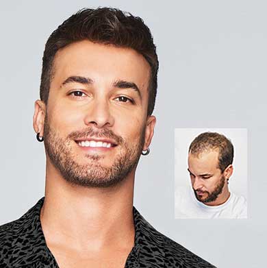 non-surgical hair restoraiton columbus ashland cleveland ohio