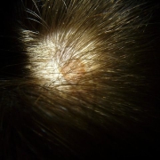 irritant dermatitis scalp