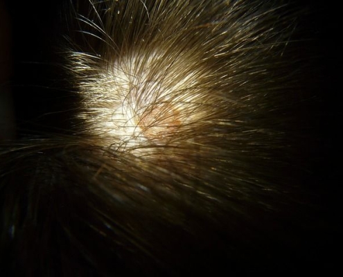 irritant dermatitis scalp