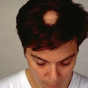 alopecia areata