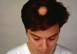 alopecia areata