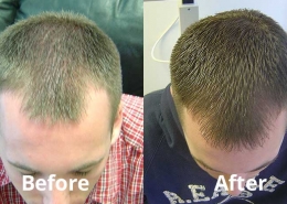 laser hair therapy results