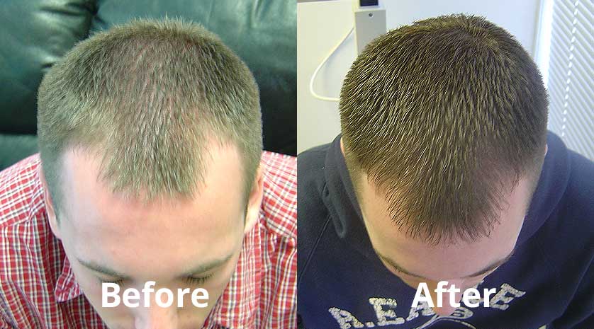 Laser Hair Growth Treatment  Laser Therapy Birmingham  Optima Hair