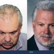 hair transplant surgeon cleveland ohio