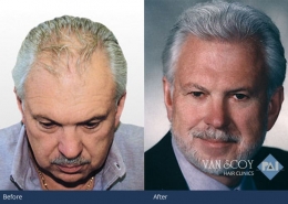 hair transplant surgeon cleveland ohio