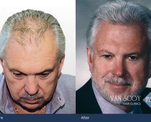 hair transplant surgeon cleveland ohio