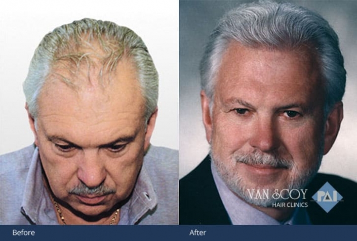 hair transplant surgeon cleveland ohio