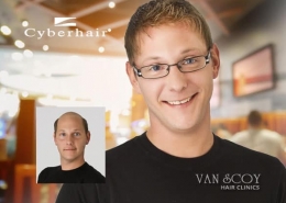 cyberhair mens hair replacement ohio