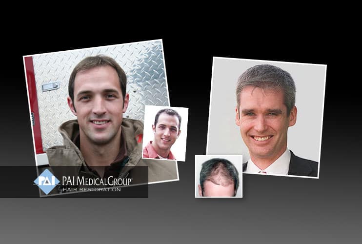 hair transplants cleveland ashland columbus ohio