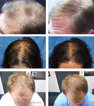 laser hair loss treatment therapy ohio