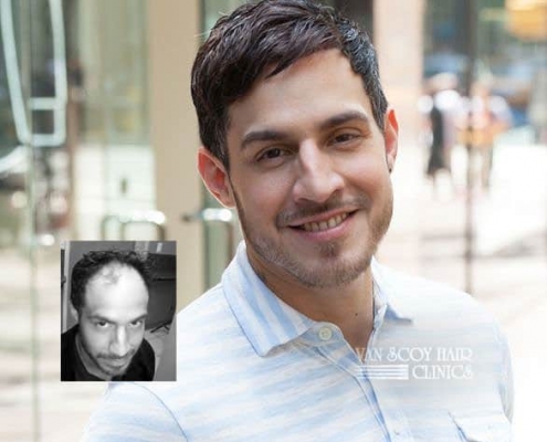 Mens non-surgical hair replacement restoration ohio