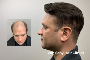 Men's Hair Loss Replacement Treatments - Cleveland, Columbus, Ashland