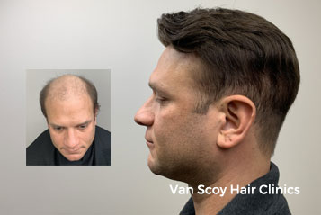 Men's Hair Loss Replacement Treatments - Cleveland, Columbus, Ashland Men's Hair Loss Replacement Treatments - Cleveland, Columbus, Ashland