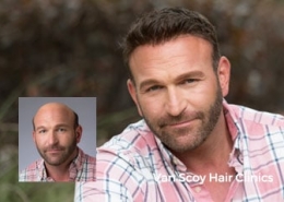 non-surgical mens hair replacement ashland ohio