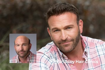 non-surgical mens hair replacement ashland ohio