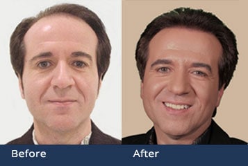 Hair Transplant Clinic Columbus Ashland Ohio