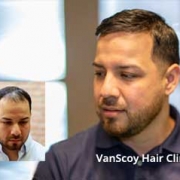 mens non-surgical hair replacement systems hair direct ohio