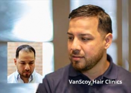 mens non-surgical hair replacement systems hair direct ohio