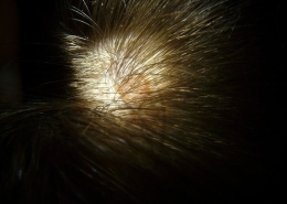 irritant dermatitis scalp