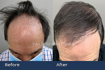 Mens Hair Transplant Doctor Cleveland Columbus Ashland Ohio