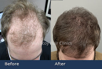 cleveland hair transplant clinic results