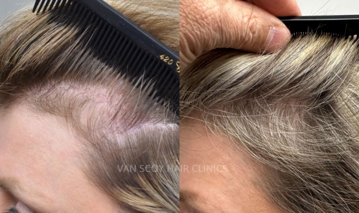 female hair loss alopecia PRP Laser Hair Loss Treatment Cleveland Ohio
