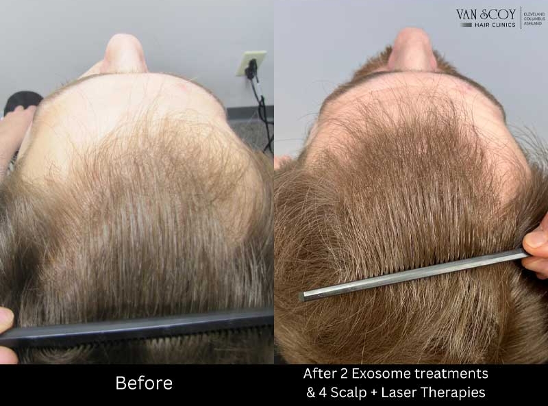 Enhanced Hair Loss Treatment Therapy Ohio