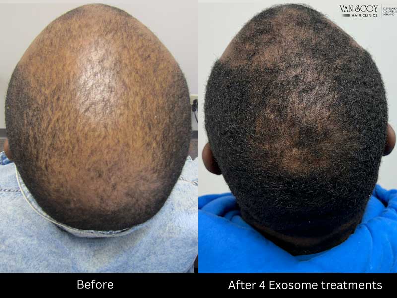 Enhanced Hair Loss Treatment Therapy Ohio