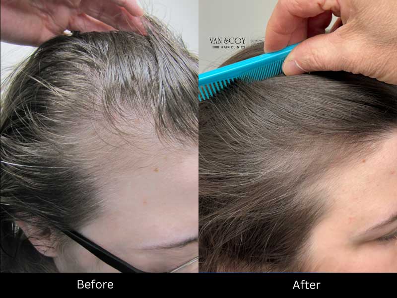 Enhanced Hair Loss Treatment Therapy Ohio