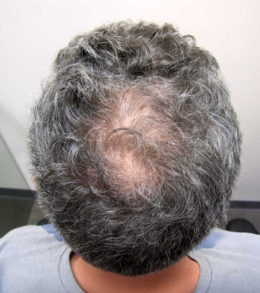 PRP-Before