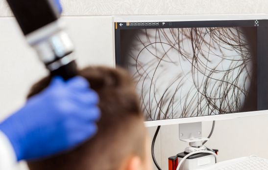 Trichoscopy of hair and scalp closeup. Precise approach to hair and scalp health diagnosis.